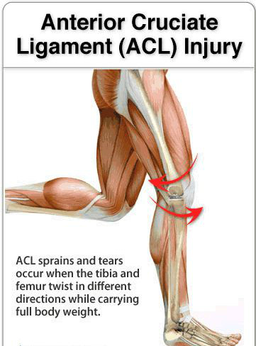 What is an ACL tear | Dr Brian Cable M.D. | Brian Cable MD