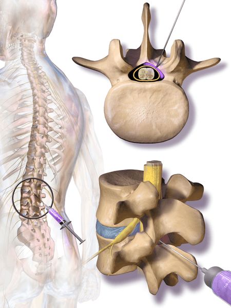 What is a herniated disc | Dr Brian Cable M.D. | Dr Brian Cable MD
