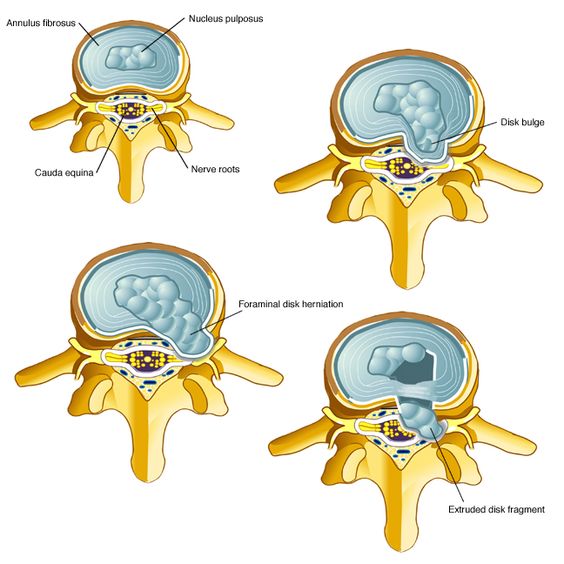 What is a herniated disc | Dr Brian Cable M.D. | Dr Brian Cable MD