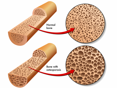 What is osteoporosis | Dr Brian Cable MD | Brian M Cable MD